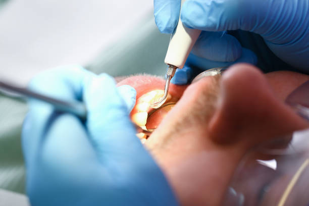 Best Knocked-Out Tooth (Avulsed Tooth) Treatment in Holt, AL